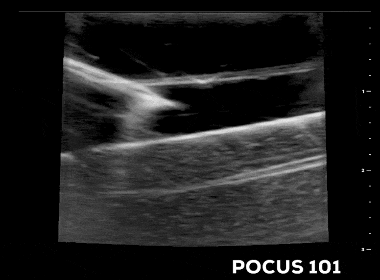 Ultrasound Guided Central Line CVL Long Axis Needle in Vessel Dynamic