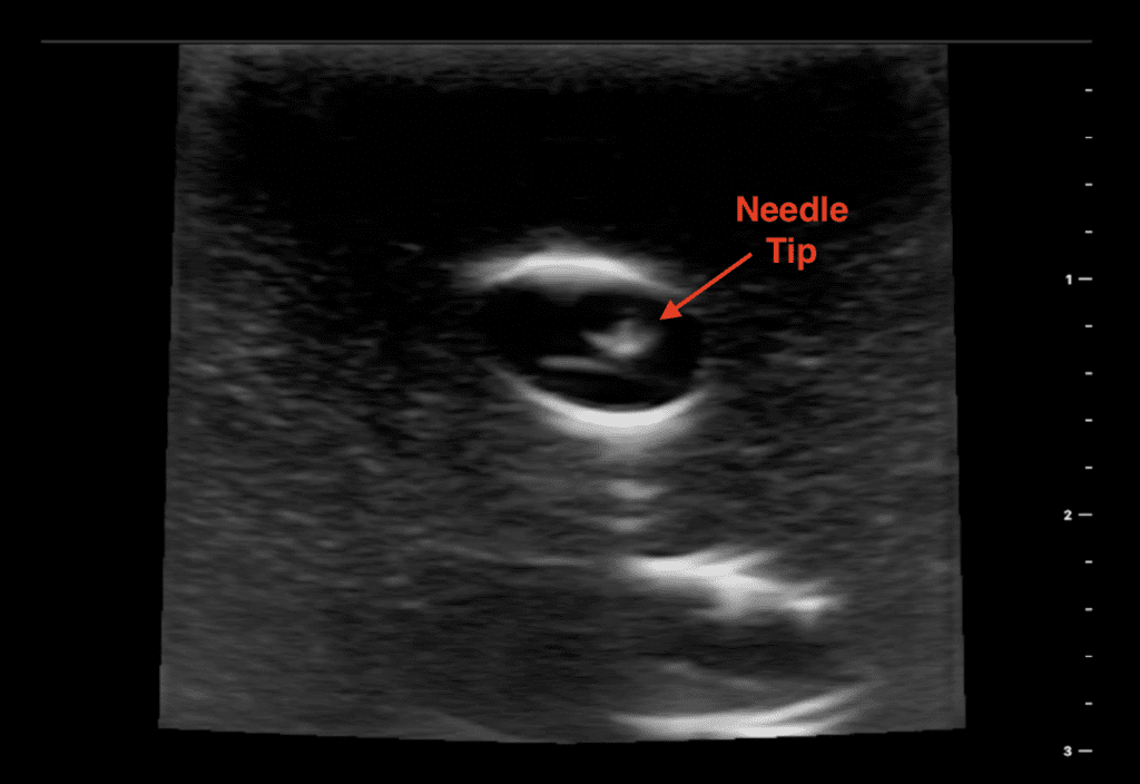 Ultrasound Guided Central Line CVL Short Axis Needle in Vessel