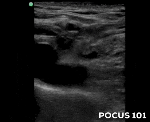 Ultrasound Guided Central Line CVL Supraclavicular Subclavian Vein