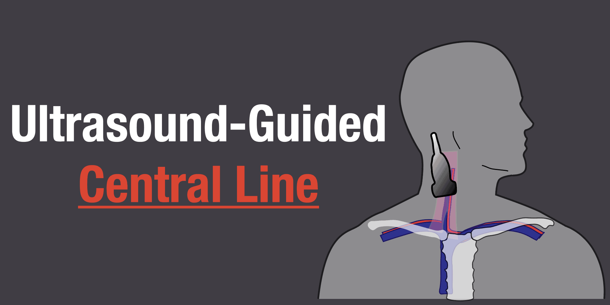 Ultrasound Guided Central Line Featured Image Illustration CVL