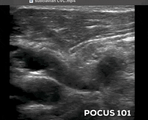 Ultrasound Guided Central Line Subclavian Infraclavicular